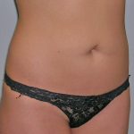 Liposuction Before & After Patient #1226