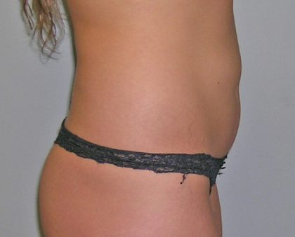 Liposuction Before & After Patient #1226