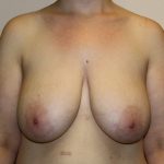 Breast Reduction Before & After Patient #1003