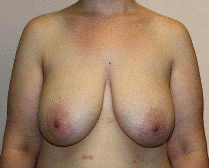 Breast Reduction Before & After Patient #1003