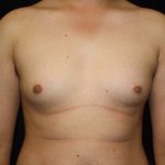 Gynecomastia Before & After Patient #1247