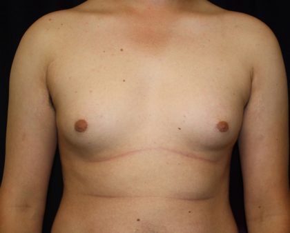 Gynecomastia Before & After Patient #1247