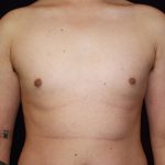 Gynecomastia Before & After Patient #1247