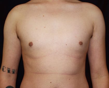 Gynecomastia Before & After Patient #1247