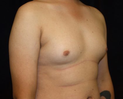 Gynecomastia Before & After Patient #1247