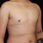 Gynecomastia Before & After Patient #1247