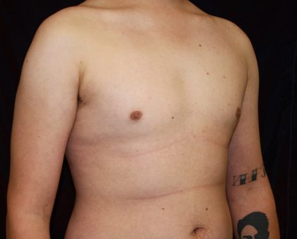 Gynecomastia Before & After Patient #1247