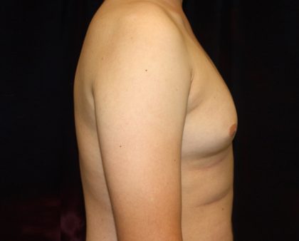 Gynecomastia Before & After Patient #1247