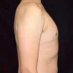 Gynecomastia Before & After Patient #1247