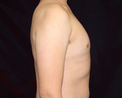 Gynecomastia Before & After Patient #1247