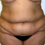 Tummy Tuck Before & After Patient #542