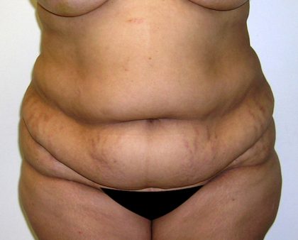 Tummy Tuck Before & After Patient #542