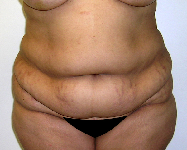 Tummy Tuck Before & After Patient #542