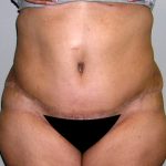 Tummy Tuck Before & After Patient #542