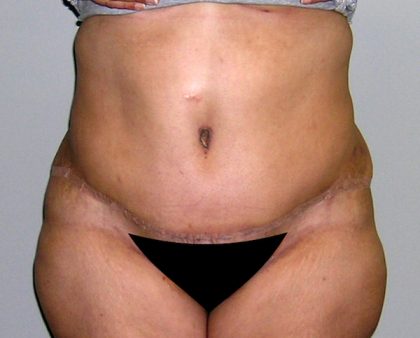 Tummy Tuck Before & After Patient #542