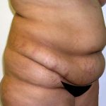 Tummy Tuck Before & After Patient #542