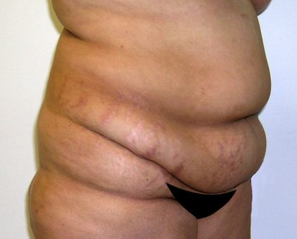 Tummy Tuck Before & After Patient #542