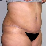 Tummy Tuck Before & After Patient #542