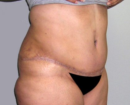 Tummy Tuck Before & After Patient #542