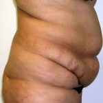 Tummy Tuck Before & After Patient #542