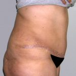 Tummy Tuck Before & After Patient #542