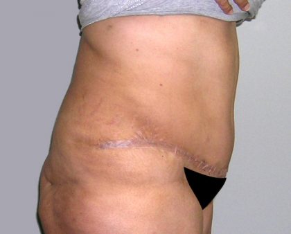 Tummy Tuck Before & After Patient #542