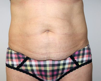 Tummy Tuck Before & After Patient #705