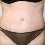 Tummy Tuck Before & After Patient #705