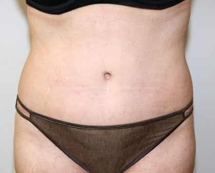 Tummy Tuck Before & After Patient #705