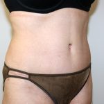 Tummy Tuck Before & After Patient #705