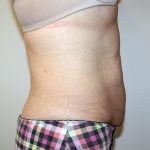 Tummy Tuck Before & After Patient #705