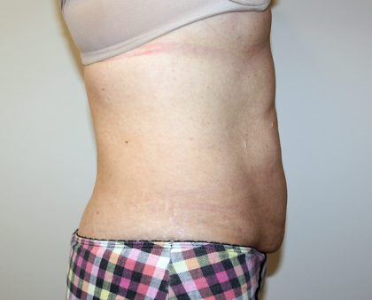 Tummy Tuck Before & After Patient #705