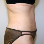 Tummy Tuck Before & After Patient #705