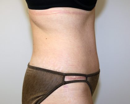 Tummy Tuck Before & After Patient #705