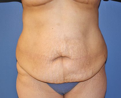 Tummy Tuck Before & After Patient #570