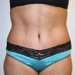 Tummy Tuck Before & After Patient #570