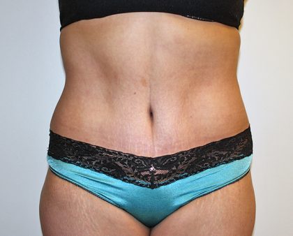 Tummy Tuck Before & After Patient #570