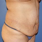 Tummy Tuck Before & After Patient #570