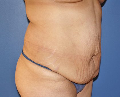 Tummy Tuck Before & After Patient #570