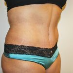 Tummy Tuck Before & After Patient #570