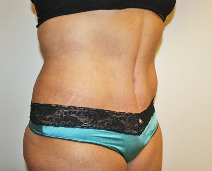 Tummy Tuck Before & After Patient #570