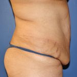 Tummy Tuck Before & After Patient #570