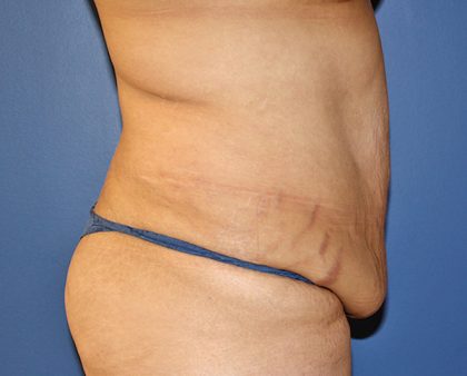 Tummy Tuck Before & After Patient #570