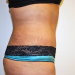 Tummy Tuck Before & After Patient #570