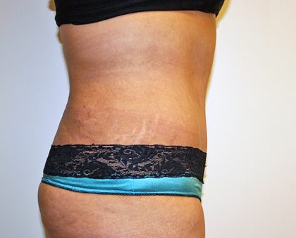 Tummy Tuck Before & After Patient #570