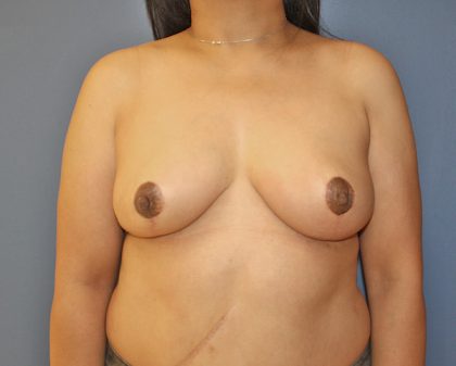 Breast Reduction Before & After Patient #968