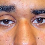 Blepharoplasty Before & After Patient #733