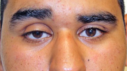 Blepharoplasty Before & After Patient #733