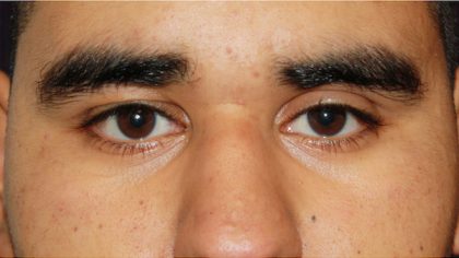 Blepharoplasty Before & After Patient #733