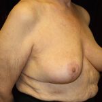 Breast Reduction Before & After Patient #954